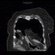 Morgagni hernia, diaphragmatic hernia, large, congenital: CT - Computed tomography
